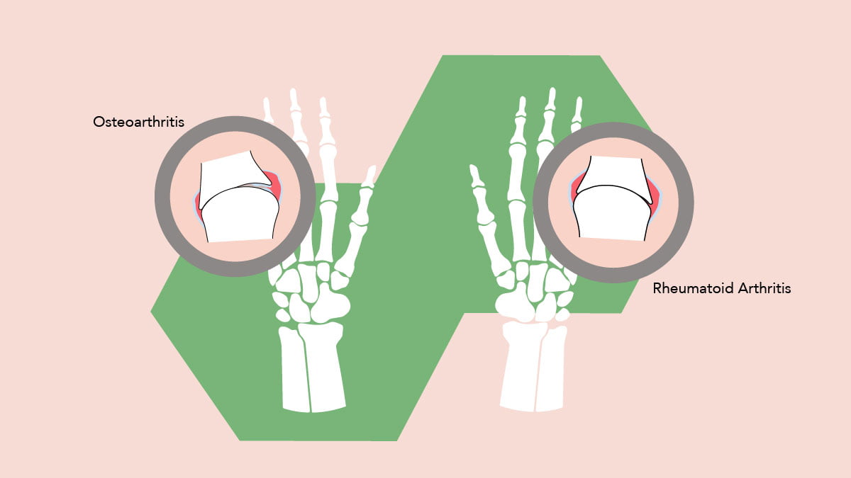 Illustration of the two main types of arthritis osteoarthritis and rheumatoid arthritis