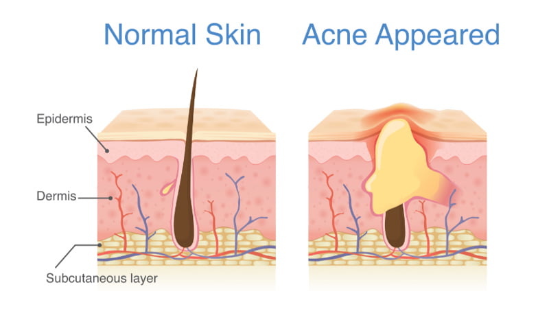 Illustration of normal skin vs skin with acne