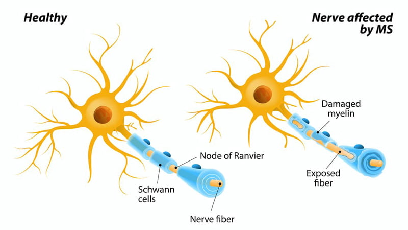 Illustration of nerve cells affected by MS