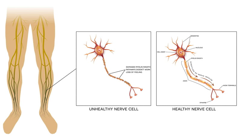 Illustration of a healthy nerve cell and neuropathic nerve cell