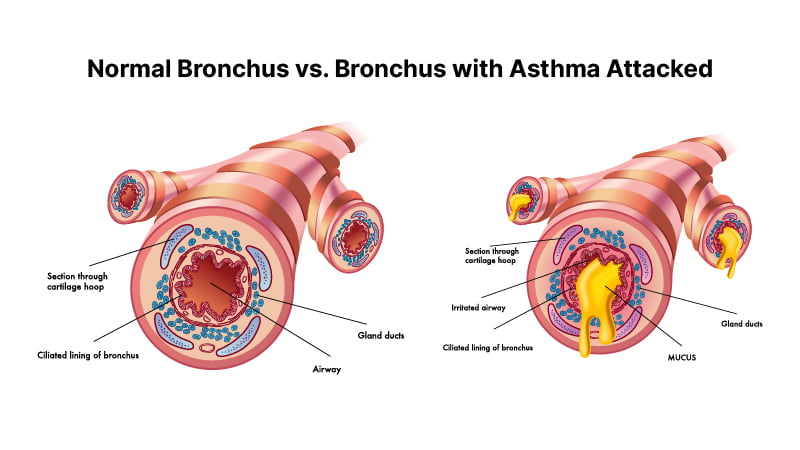 Bronchospasm during asthma attack illustration