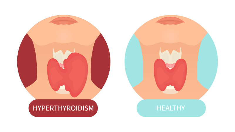 healthy and hyperthyroidism illustration