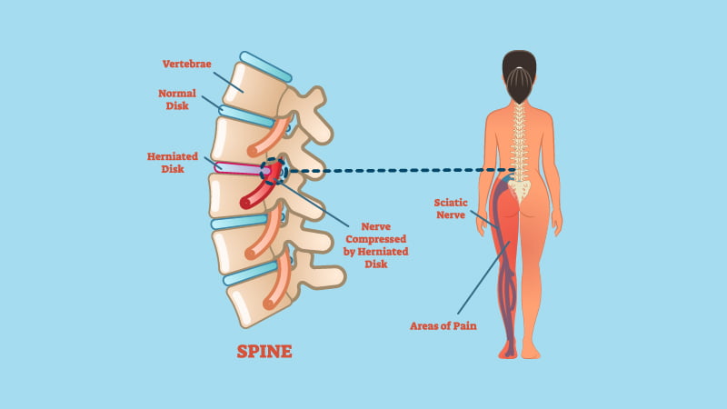 Sciatica illustration with spine and human anatomy on blue background