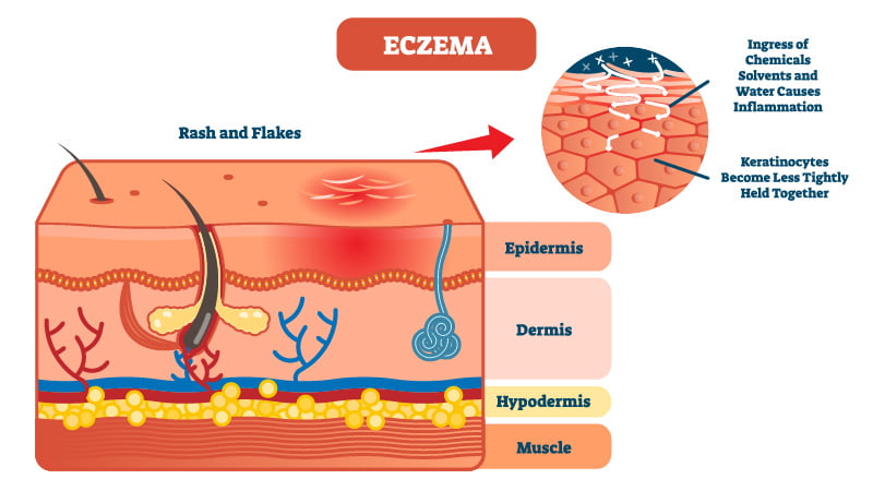 Eczema Illustration