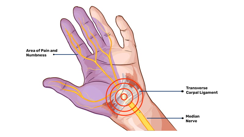 Illustration of Carpal Tunnel Syndrome