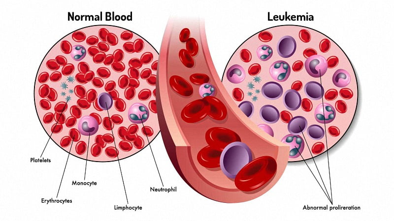Illustration of Normal Blood vs with Leukemia