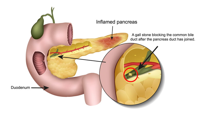 Acute Pancreatitis Illustration on white background
