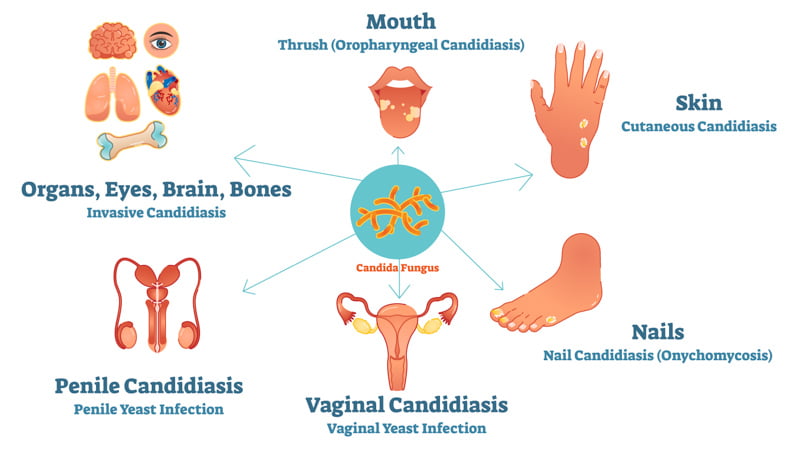 Candidiasis Illustration Different Areas of the Body