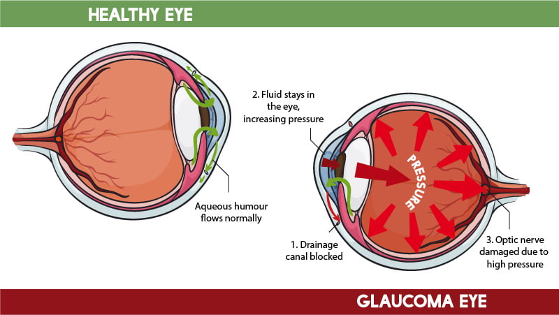 Illustration of healthy eye vs glaucoma eye on white background