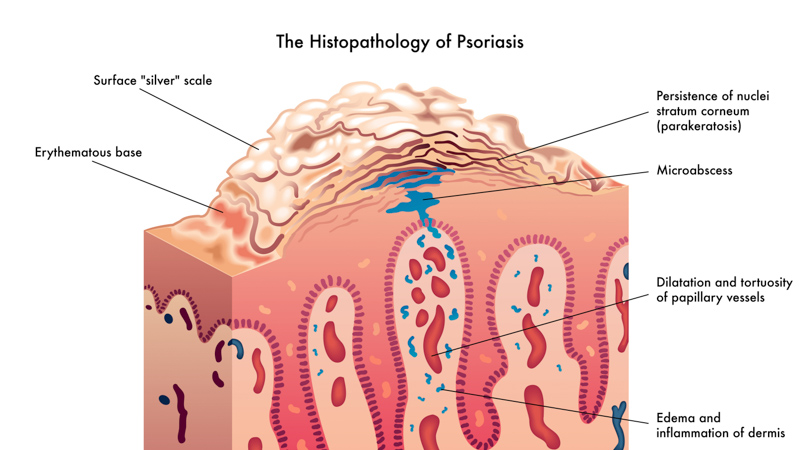 Illustration of Psoriasis 